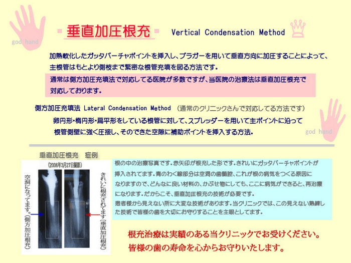垂直加圧根充.jpg